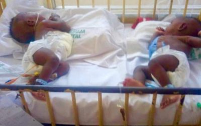 UATH doctors successfully separate conjoined twins in Gwagwalada